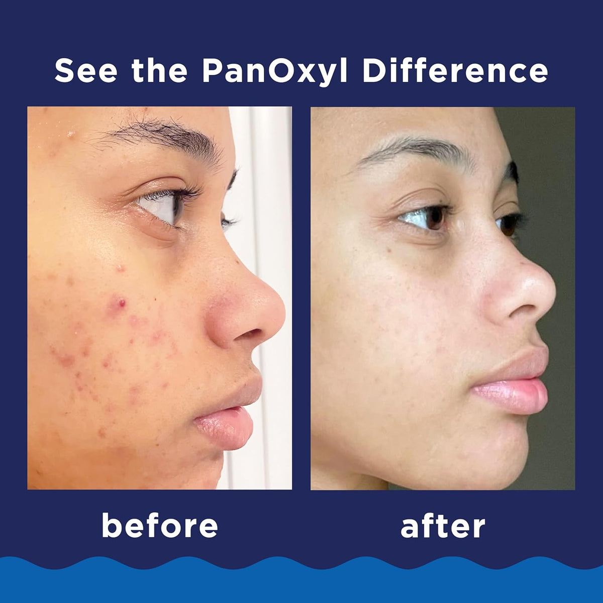 Benzoyl Peroxide Acne Foaming Wash, Maximum Strength, Daily Acne-Fighting Face and Body Cleanser, Face Wash to Clear, Treat and Prevent Acne Pimples and Stubborn Breakouts, 5.5 Oz Tube